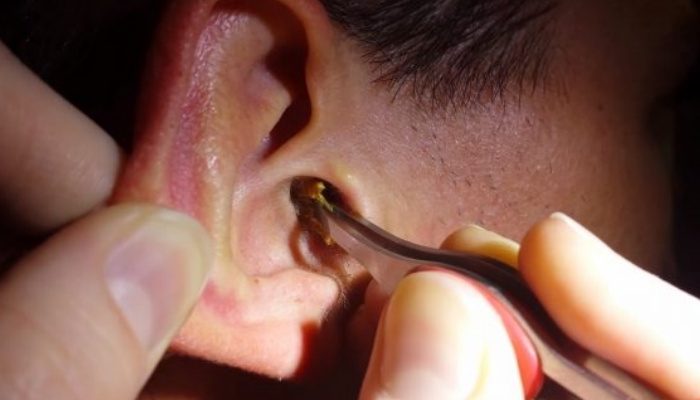Xử lý côn trùng chui vào tai